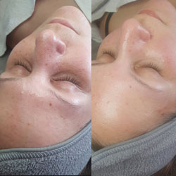 Aqua Peeling Vorher-Nachher aus unserem Studio