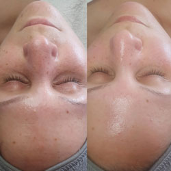 Aqua Peeling Vorher-Nachher aus unserem Studio