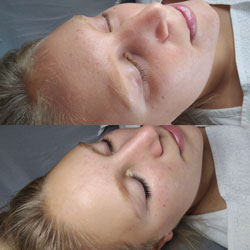 Aqua Peeling Vorher-Nachher aus unserem Studio