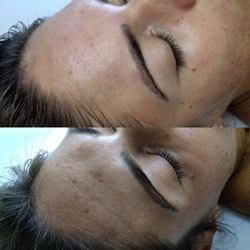 Microdermabrasion Vorher-Nachher aus unserem Studio