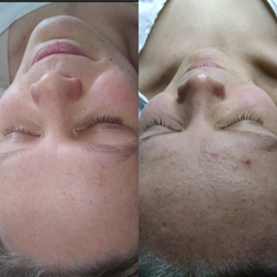 Microdermabrasion Vorher-Nachher aus unserem Studio