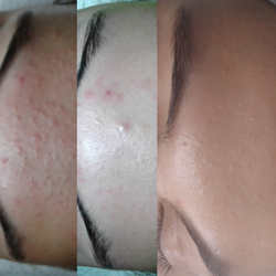 Microdermabrasion Behandlungsserie aus unserem Studio